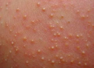 L'acné chez les nouveau-nés comme cause d'une éruption cutanée sur les joues d'un enfant