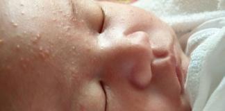 Causes de l'acné chez les nouveau-nés: photos, symptômes, méthodes efficaces de traitement et de prévention