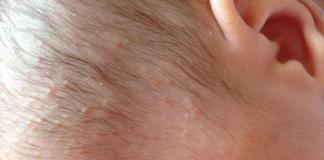 Moderne Methoden zur Behandlung und Vorbeugung von Hautausschlägen bei Kindern